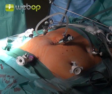 Inserindo a agulha de Veress e colocação dos trocaters