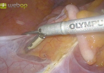 Dissecando a junção ileocecal