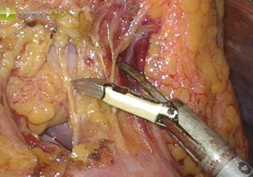 Retirada do grande omento