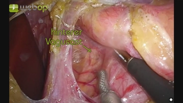 Dissecção dos Pilares Diafragmáticos com Exposição do Esôfago Distal
