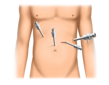 Inserção de Trocares e Exploração da Junção Gastroesofágica