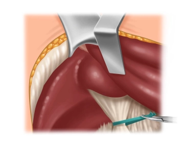 Preparação do Hilo Hepático