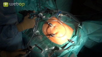 Criação de Pneumoperitônio / Colocação de Trocares de Trabalho