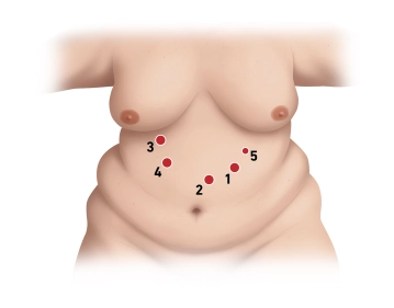 Acesso à câmera; colocação do trocater