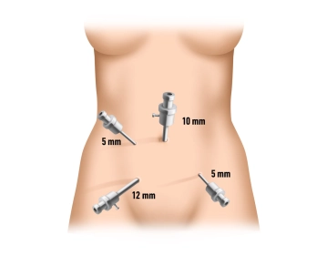 Posicionamento dos trocartes