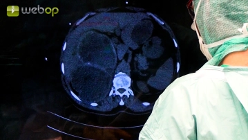 Coleta de achados; Adesiólise; Preparação do pericisto extra-hepático no lobo hepático esquerdo