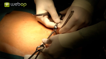 Posicionamento; Colocação dos trocartes