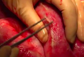 Inspeção e Adesiólise