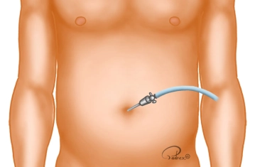 Pequeña incisión cutánea profunda en el ombligo
