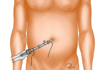 Posicionamiento del trocar