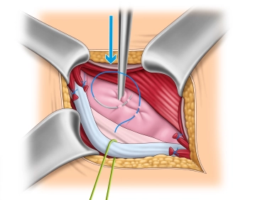 Manejo do saco herniário – Hérnia direta