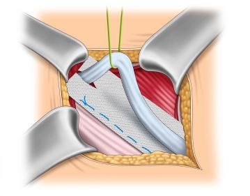 Fixação da malha no ligamento inguinal