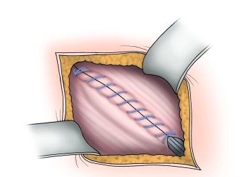 Fechamento da aponeurose externa