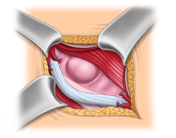 Dissecção e identificação do saco herniário