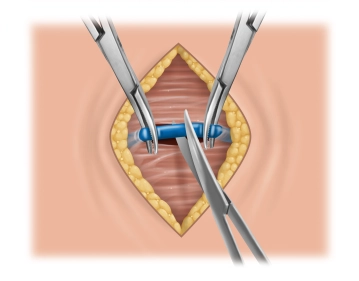 Dissecção subcutânea, divisão na linha média