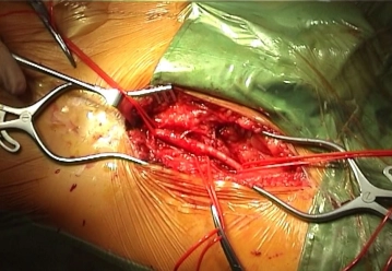 Expondo a virilha direita e a bifurcação femoral