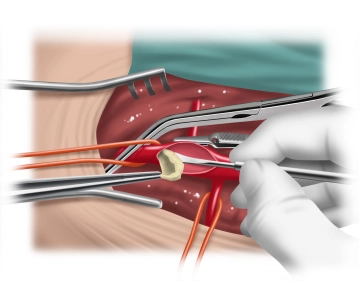 TEA da artéria femoral direita