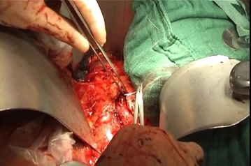 Fechando o retroperitônio