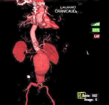Imagem dinâmica tridimensional de TC em espiral de um aneurisma de aorta abdominal infrarrenal (AAA)