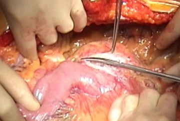 3. Abertura do retroperitônio