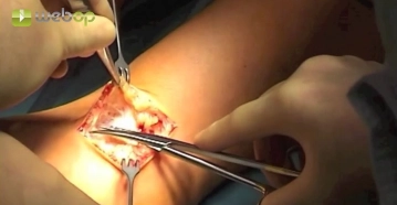 Acesso na fossa cubital direita