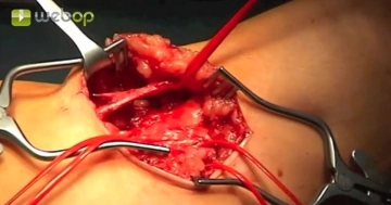 Dissecando a veia cefálica