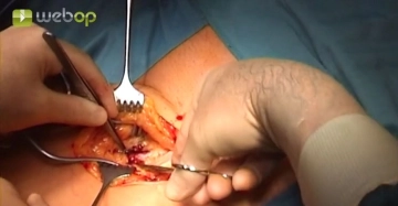 Expondo a artéria femoral superficial