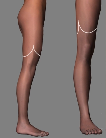 Incisão e modelagem do retalho cutâneo-muscular anterior (extensores) com transecção rápida e perfurante de tecidos moles