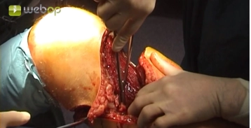 Localizando e identificando os vasos femorais