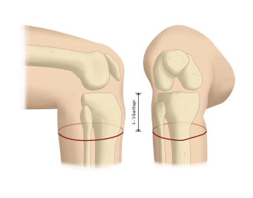 Incisão da pele e formação de um tubo de espessura total