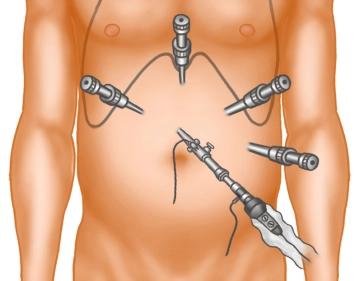 Posicionamento do trocater