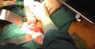 Evisceração do intestino delgado e estabelecimento do campo cirúrgico com o sistema de retrator da parede abdominal