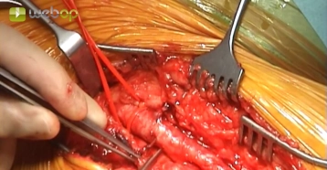 Dissecando a bifurcação femoral