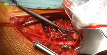 Exposição suprapoplítea do segmento P1 da artéria poplítea