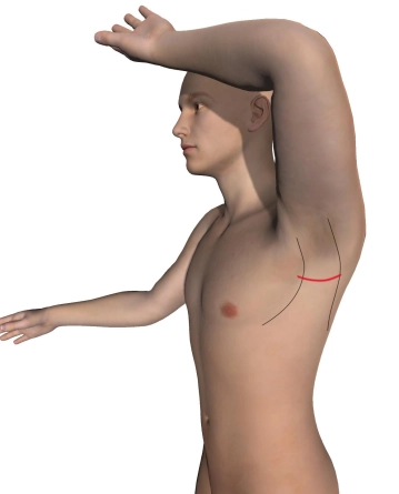 Abordagem axilar para a primeira costela esquerda