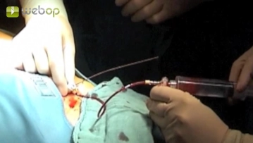 Acesso transfemoral à virilha esquerda