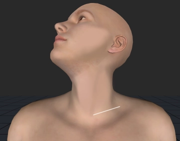 Acesso supraclavicular esquerdo