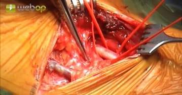 Preparação da artéria carótida comum