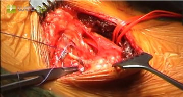 Ligadura e Divisão da Veia Jugular Externa