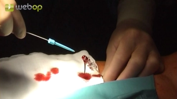 Punção da artéria femoral comum direita