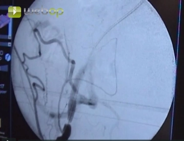 Atravessando as Estenoses com um Fio Terumo®