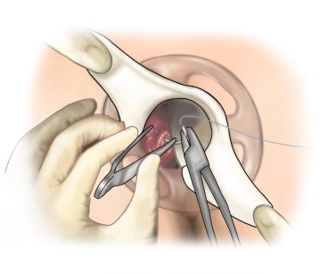 Sutura em bolsa de tabaco