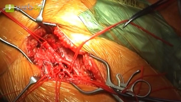 Preparação da Bifurcação Femoral