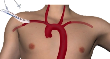 Acesso infraclavicular direito, sutura de um conduto, sondagem da aorta