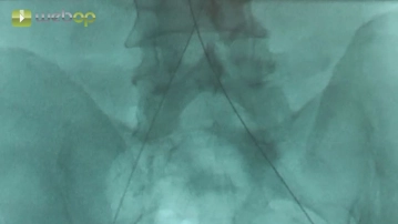Acessos transfemorais bilaterais, sondagem aórtica