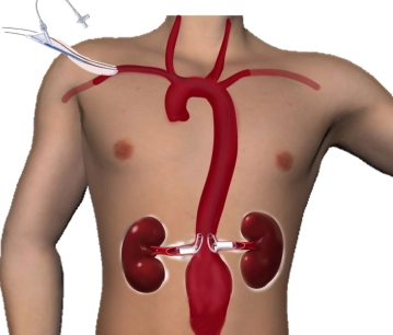 Sondagem das Artérias Renais