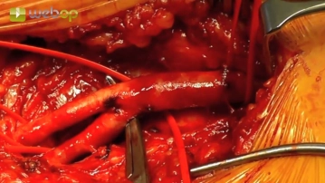 Preparação da Bifurcação Femoral