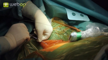 Punção da veia jugular interna direita