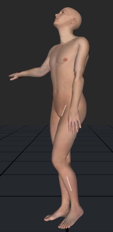 Acesso lateral à artéria tibial anterior esquerda