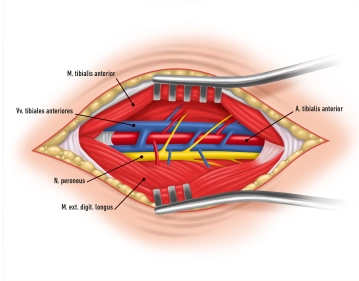 Preparação e Clampagem da Artéria Tibial Anterior